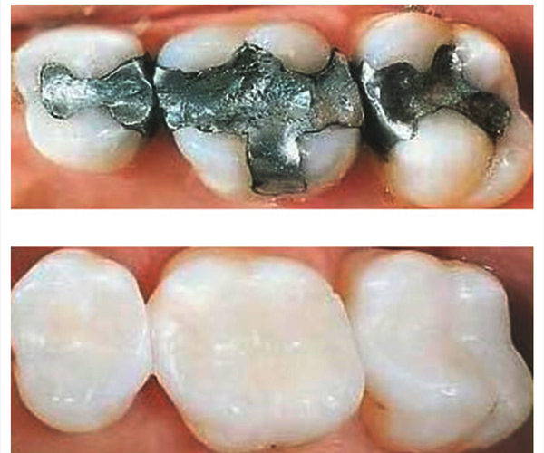 Image result for fillings teeth