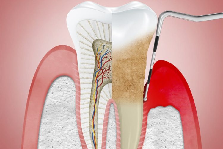 periodontitis, periodontitis treatment greece, dental tourism, gingivitis, gum disease
