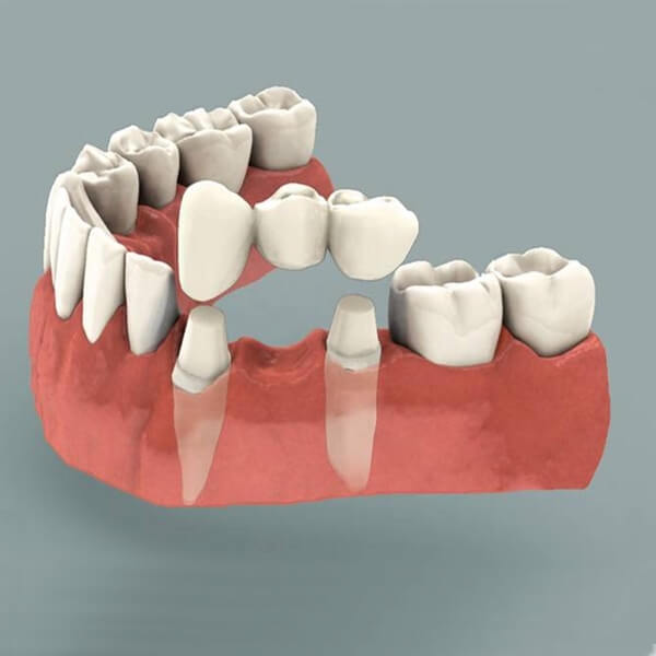 What are Dental Full Ceramic Crowns ile ilgili görsel sonucu