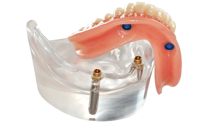 denture, dental implants, dentist crete, removable dentures